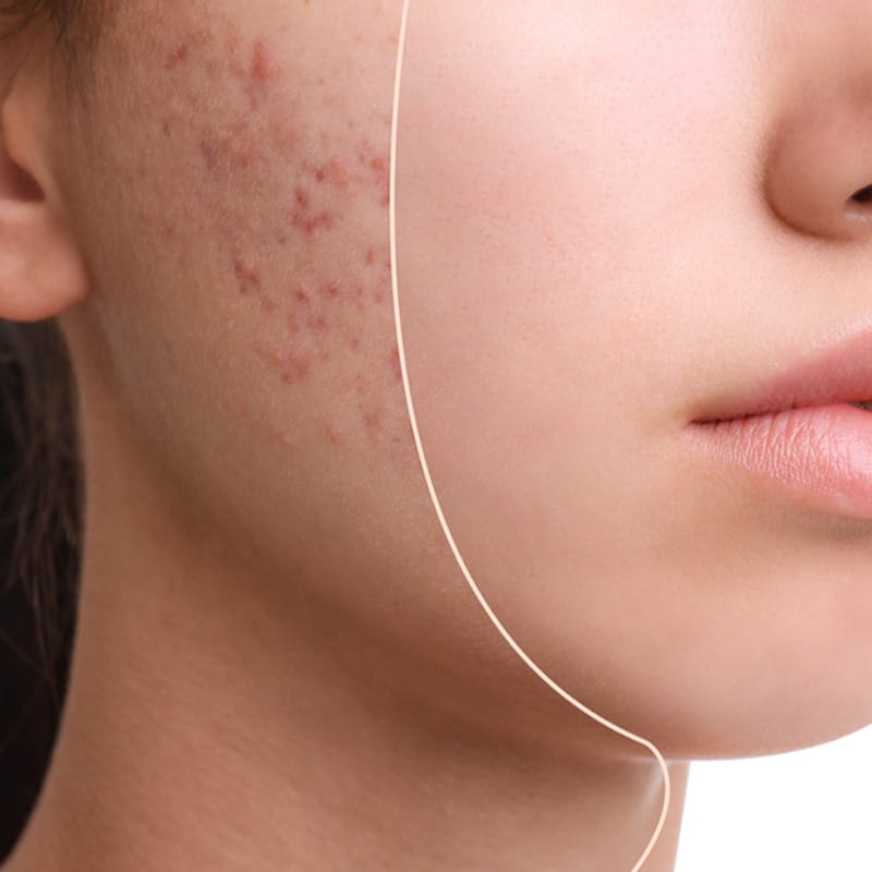 Fractional CO2 Laser Machine - Acne Scars Treatment