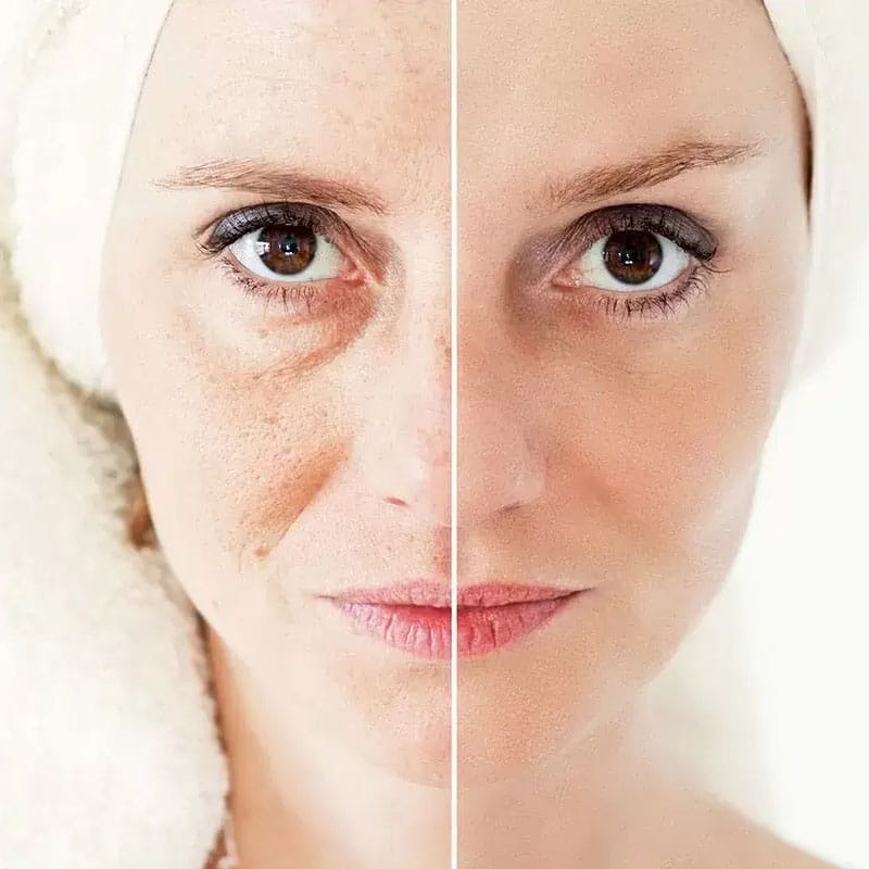 Fractional CO2 Laser Machine - Skin TighteningTreatment