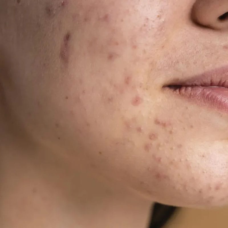 Fractional CO2 Pigmentation Treatment