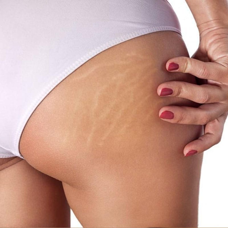 Fractional CO2 Stretch Marks Treatment Fractional CO2 Stretch Marks Treatment