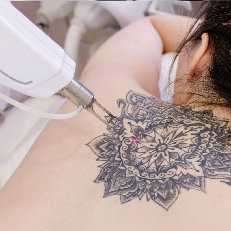 Picosecond Laser Machine - Tattoo Removal