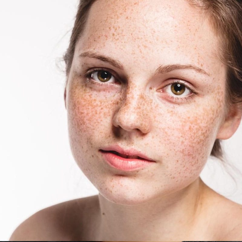 Picosecond Laser Machine - Freckles & Sun Spots