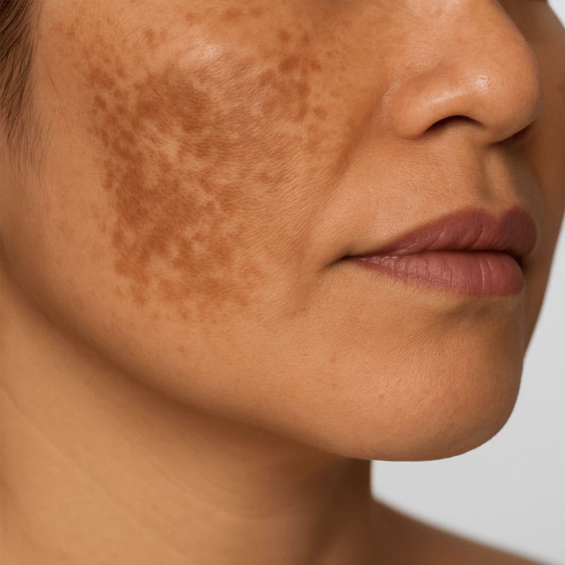 Picosecond Laser Machine - Melasma
