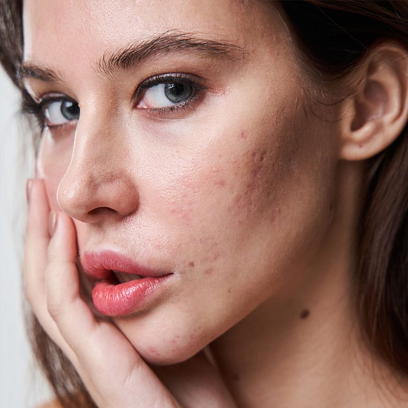 Picosecond Laser Machine – Acne Scars Picosecond Laser Machine - Acne Scars