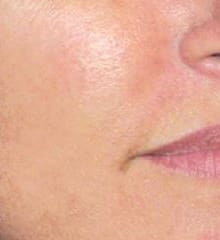 Med Spa Machines – Skin Rejuvenation After Treatment Showing Clearer Smoother and Radiant Skin