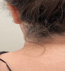Med Spa Machines – Laser Hair Removal Before Treatment Showing Unwanted Hair on Skin