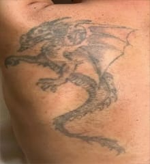 Med Spa Machines – Tattoo Removal Before Treatment Showing Dark Ink Tattoo on Skin