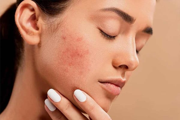 Med Spa Machines – Acne Treatment Device Reducing Acne and Promoting Clear Healthy Skin