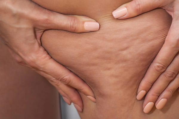 Med Spa Machines – VelaShape Cellulite Reduction Improving Skin Texture and Reducing Cellulite