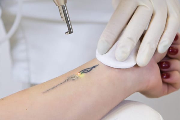 Med Spa Machines – Picosecond Laser Tattoo Removal Breaking Down Ink for Cleaner Skin
